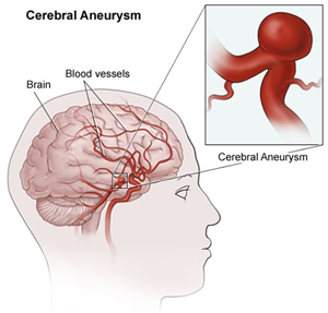 cerebral-aneurysm