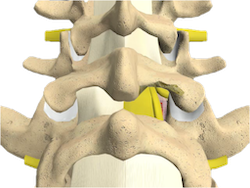 bel-fitigi-ameliyati-2