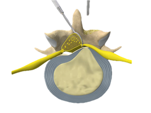 bel-fitigi-ameliyati-4