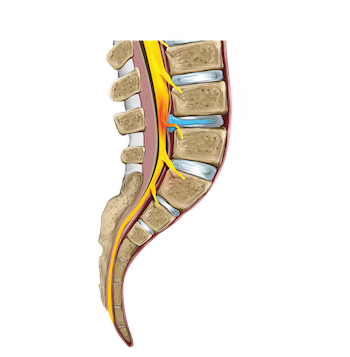 bel-fitigi-nasil-tedavi-edilir