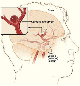 cerebral-aneurysm-nih