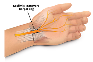 karpal-sinir-sikismasi-1-1-1