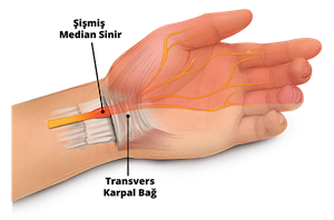 karpal-sinir-sikismasi-1