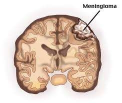 menengioma2