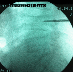 omurga-kirigi-rontgen-dr-umut-yaka2