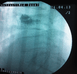omurga-kirigi-vertebroplasti-dr-umut-yaka41