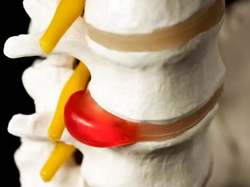 bel-fitigi-ameliyati-ile-ilgili-bilinmesi-gerekenler