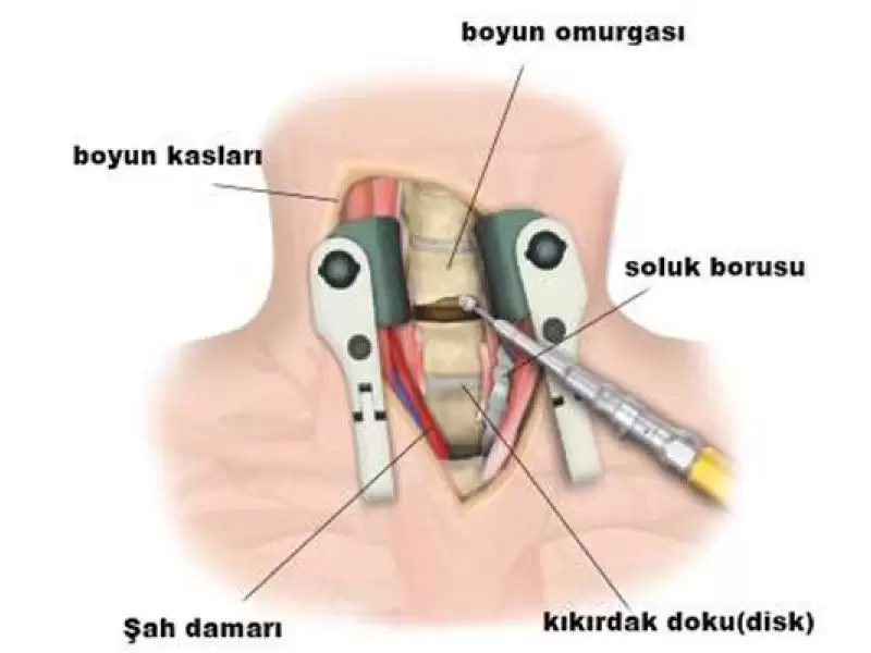 boyun-fitigi-ameliyati