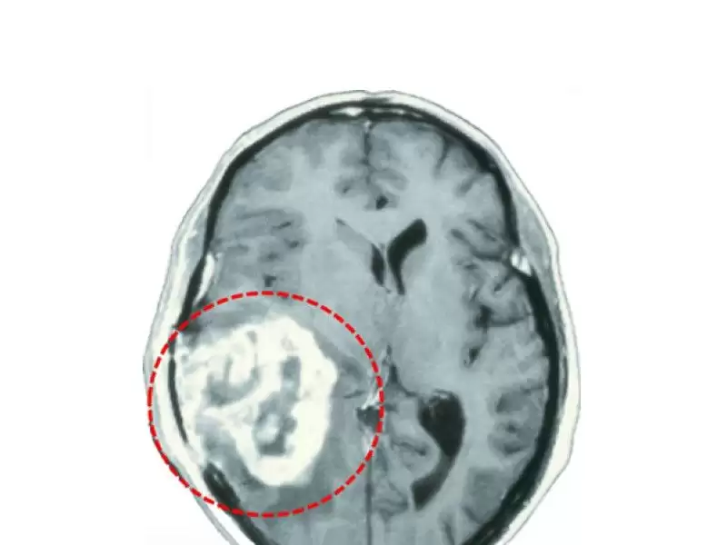 glioblastoma-multiforme