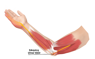 ulnar-nedir