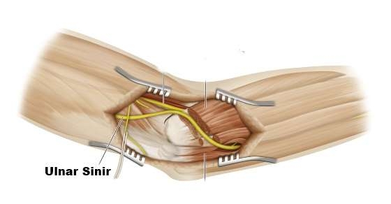 ulnar-sinir-aml-2