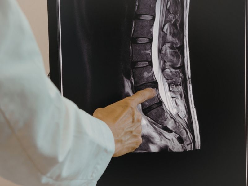 omurilik-tumoru-tanisi-ne-kadar-surede-konur